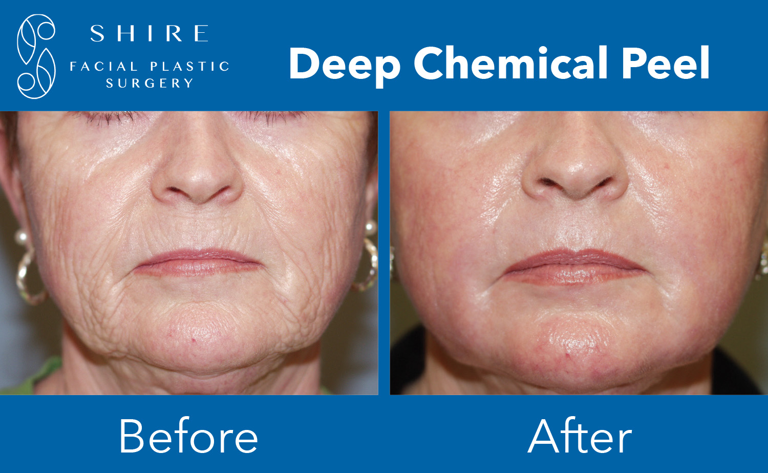 The Appeal Of The Deep Chemical Peel Shire Facial Plastic Surgery