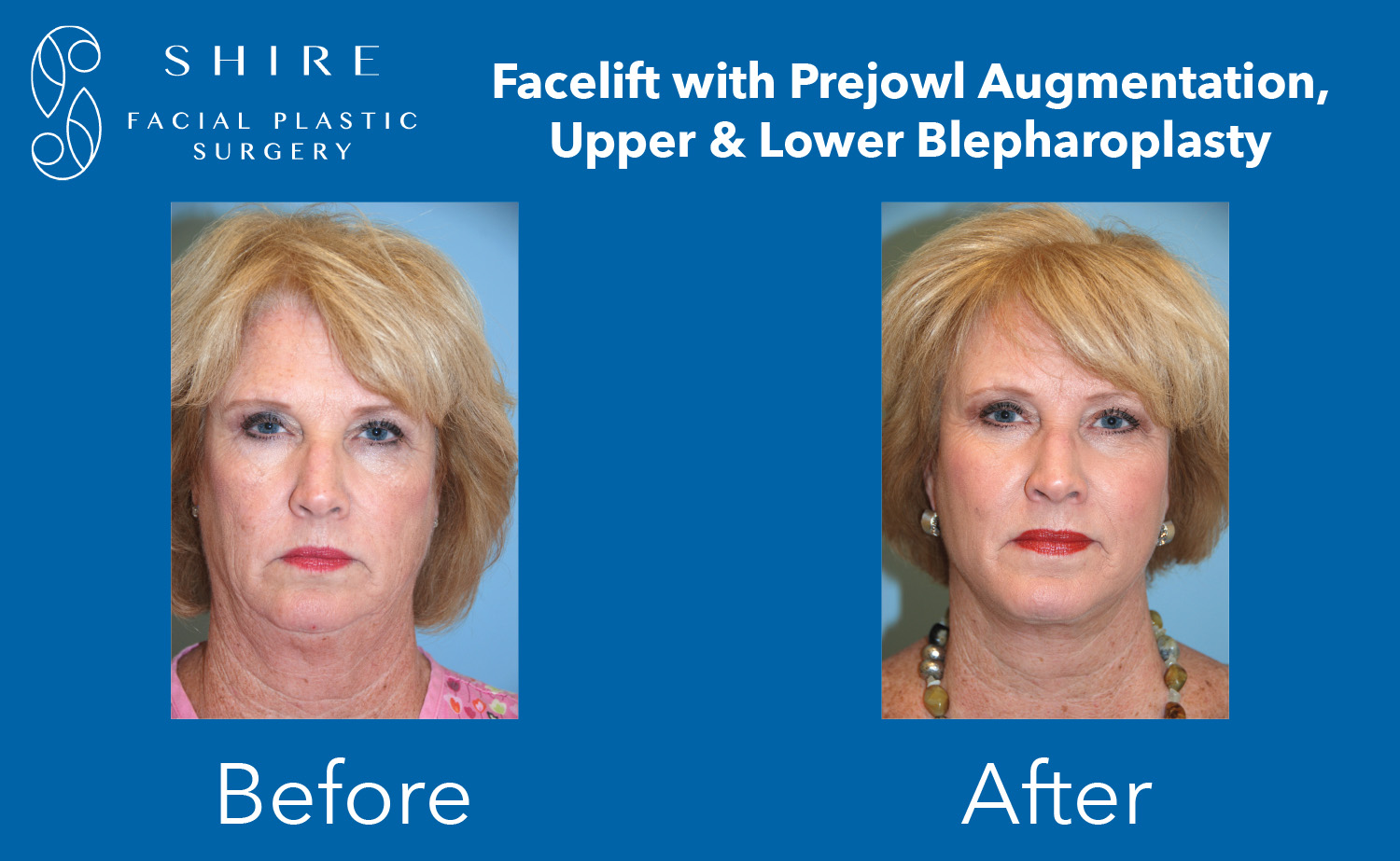 Facelift Before After Group 13 1 Shire Facial Plastic Surgery 