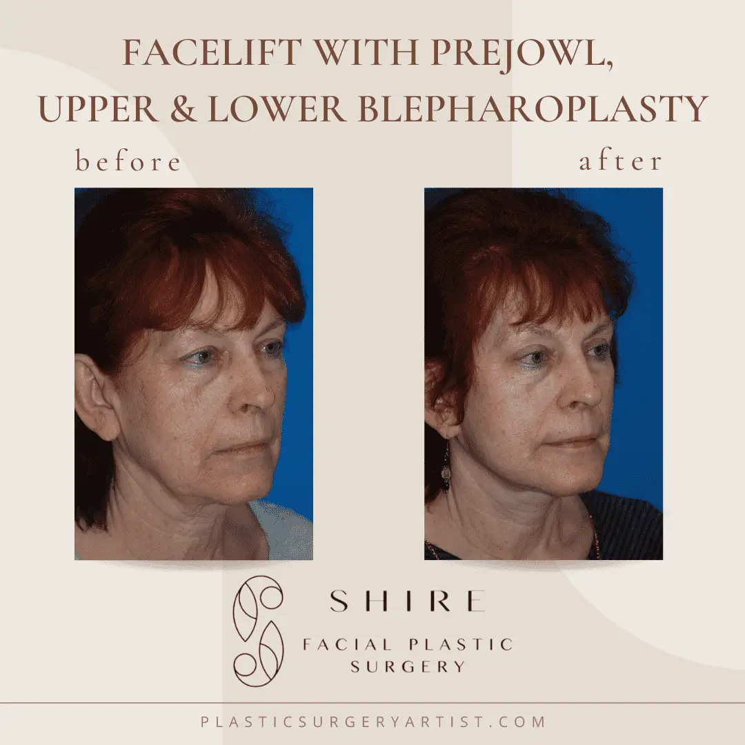 Facelift With Prejowl Upper And Lower Blepharoplasty 2 Shire Facial