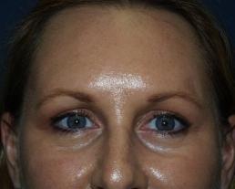 brow-liftforehead-lift--case5-after1-09-22-2014-07-56-59
