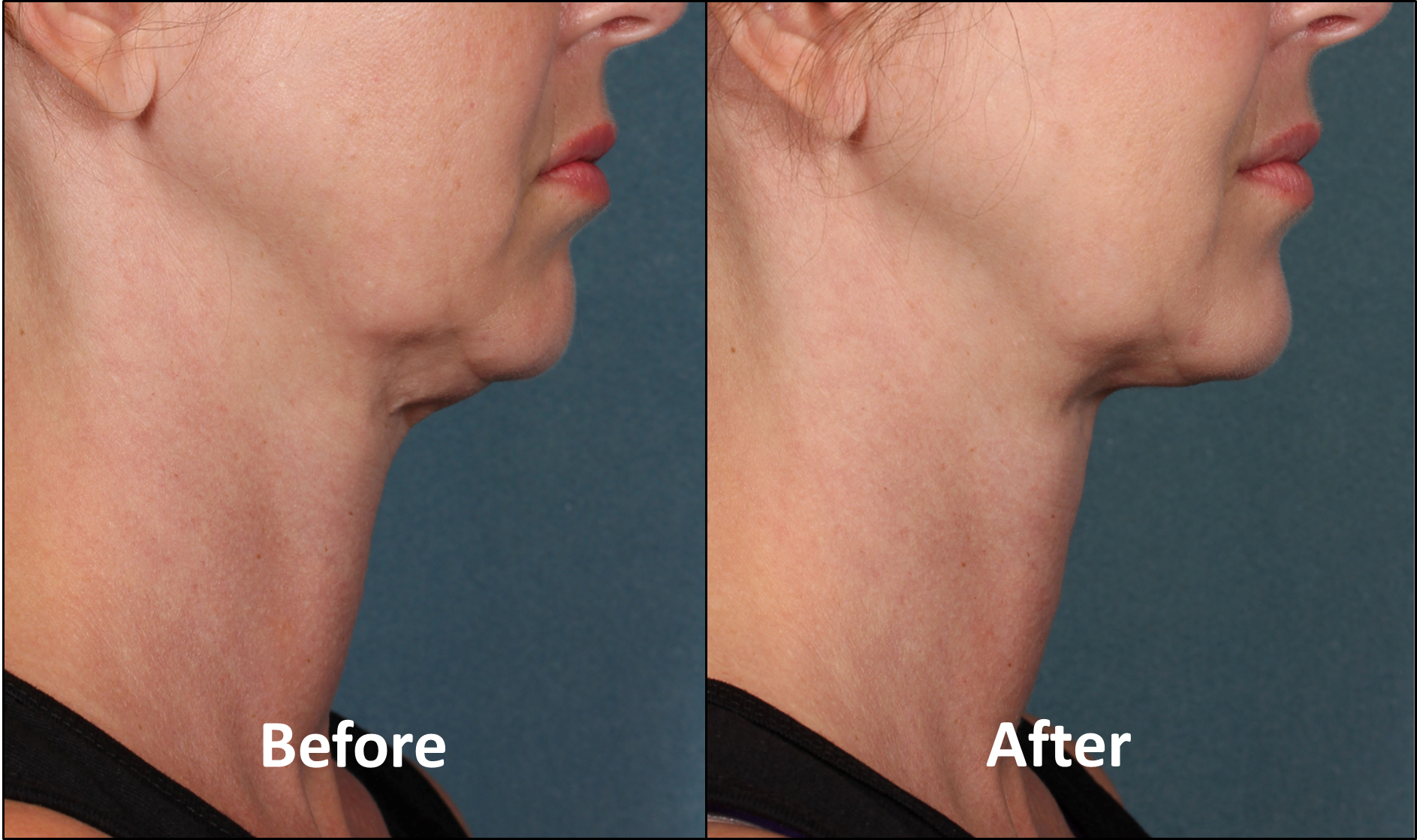 Kybella For Double Chins Chattanooga Tn Shire Facial Plastic Surgery