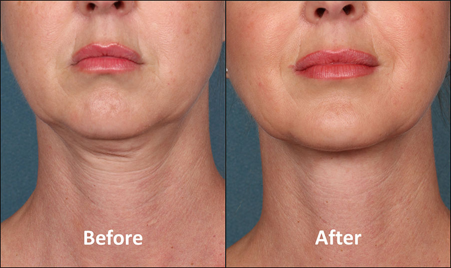 KYBELLA Patient - Before & After - Front View