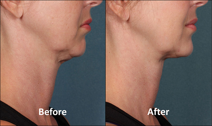 KYBELLA Patient - Before & After - Side View