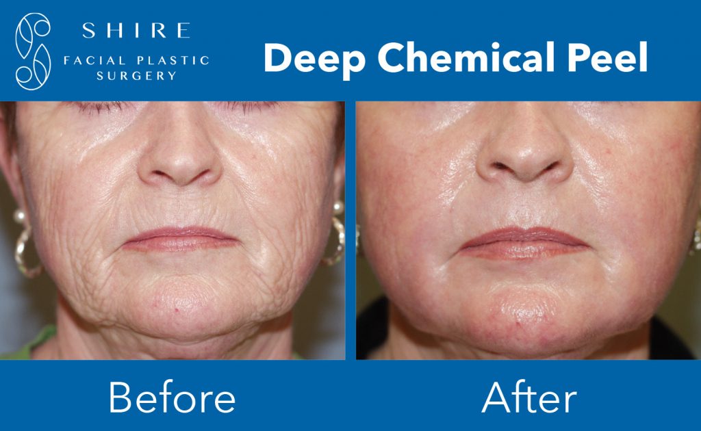 The Appeal Of The Deep Chemical Peel Shire Facial Plastic Surgery 7685