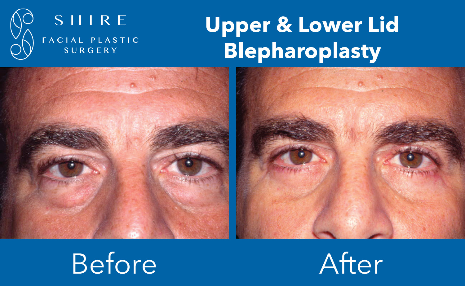 Blepharoplasty Before And After Shire Facial Plastic Surgery