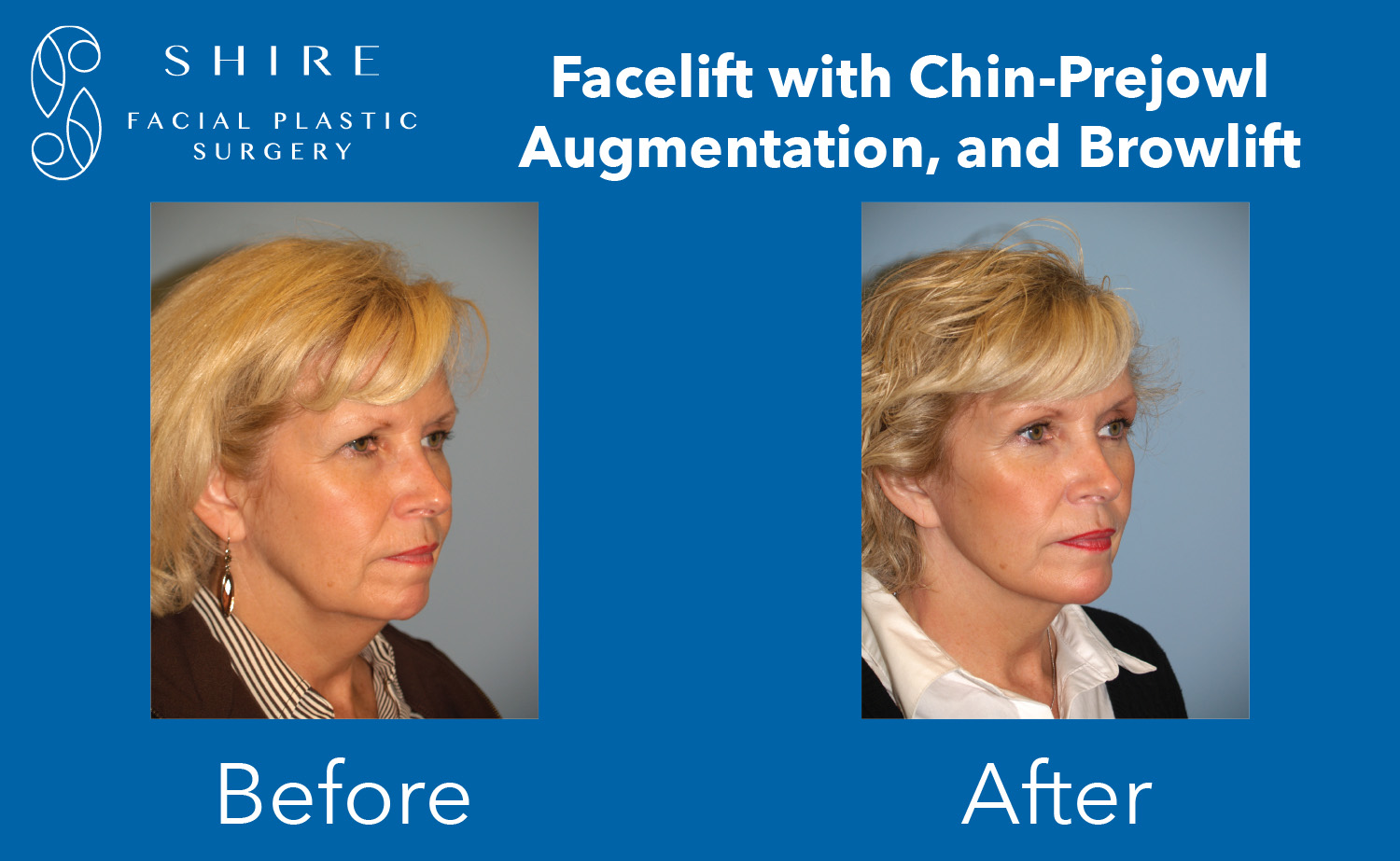 Facelift-Before-After-Group-19-1 | Shire Facial Plastic Surgery