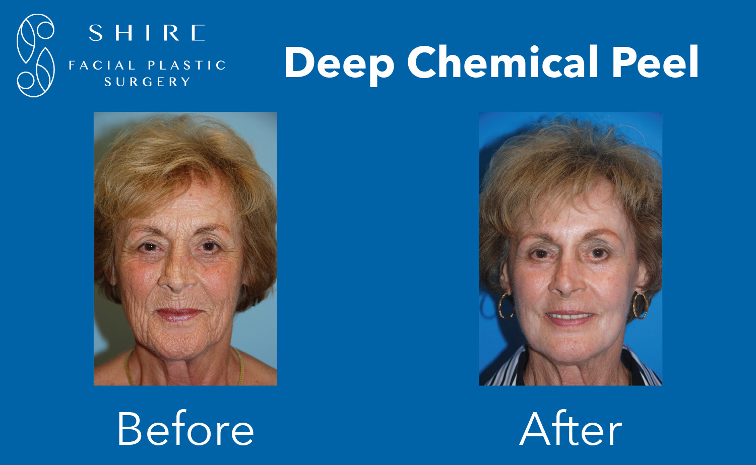 deep-chemical-peels-before-after-shire-facial-plastic-surgery