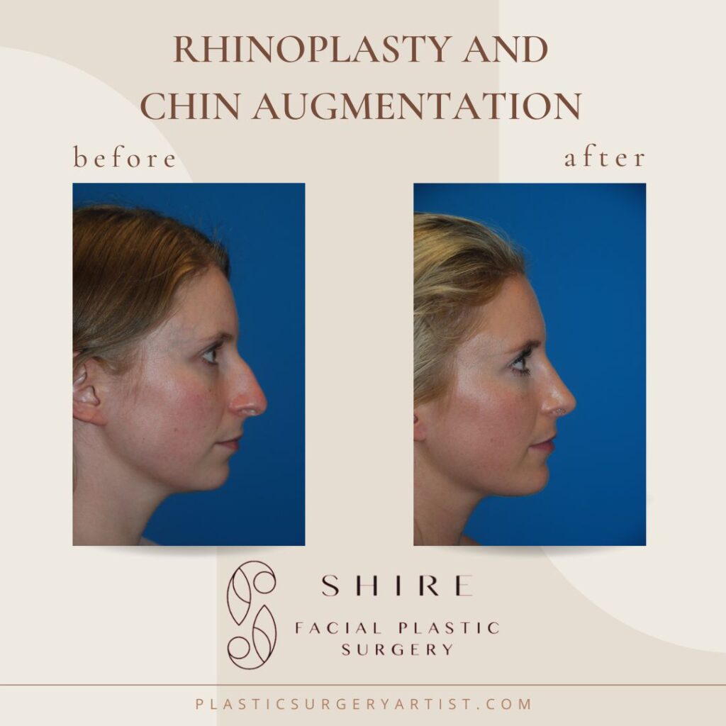 rhinoplasty and Chin augmentation 
