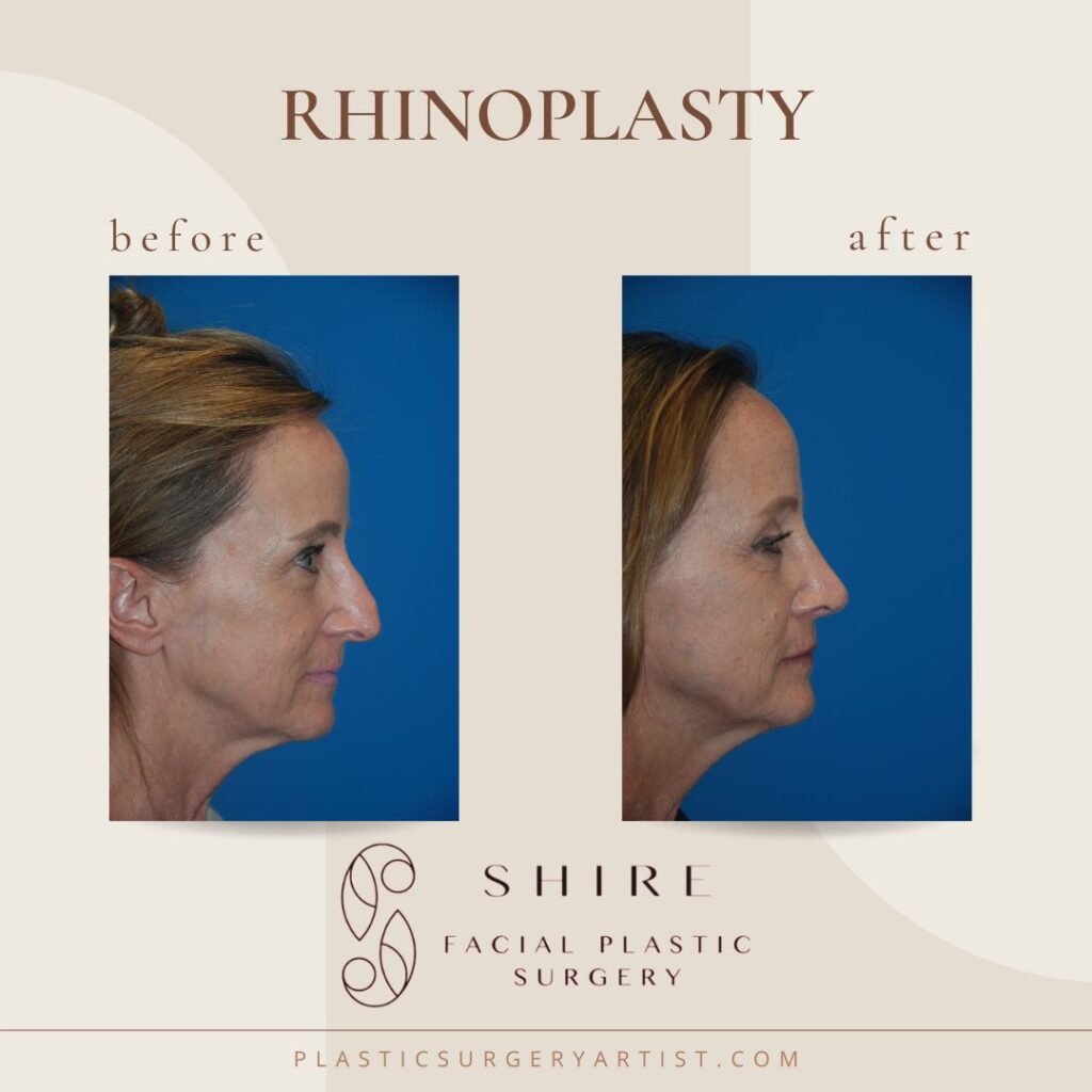 Rhinoplasty before and after - female patient 