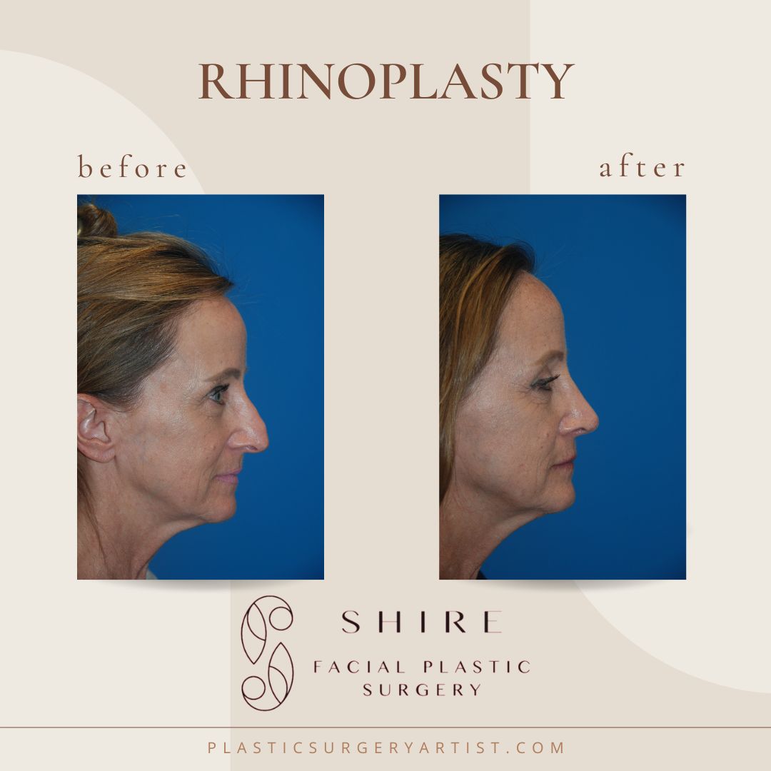 Rhinoplasty Chattanooga Nose Job Surgery Rhinoplasty Surgery