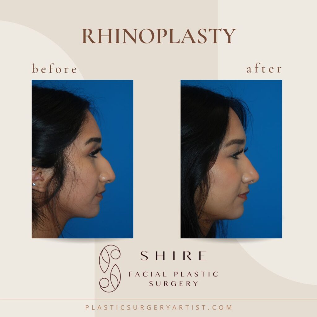 Rhinoplasty before and after - young female patient 