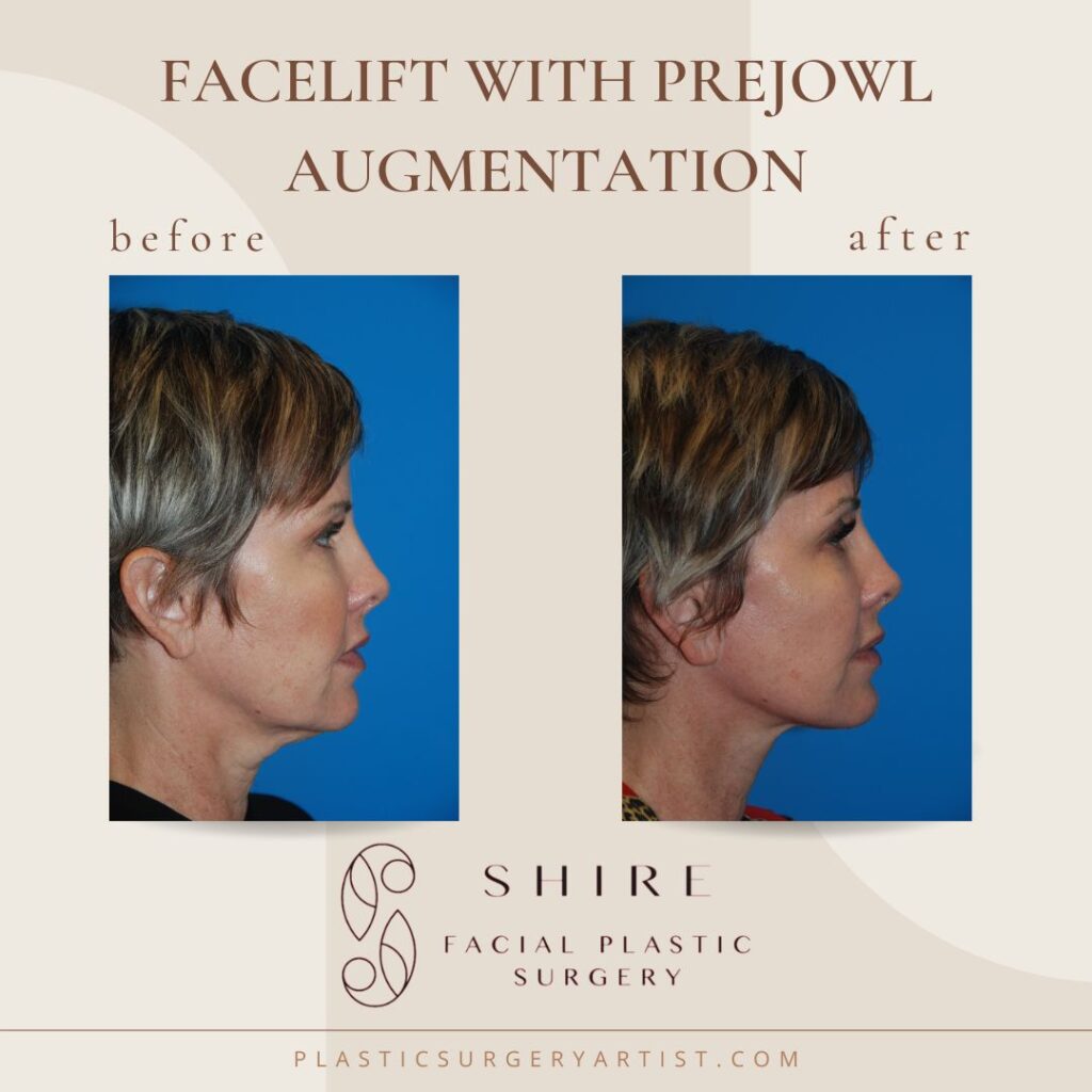 Chin Augmentation Before & After Pictures