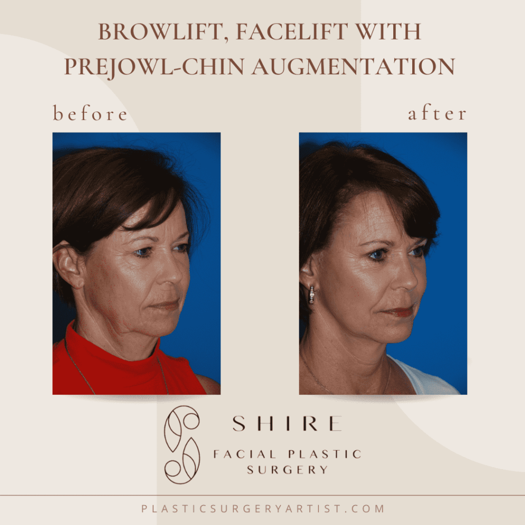 Browlift, Facelift with Prejowl Chin-Augmentation