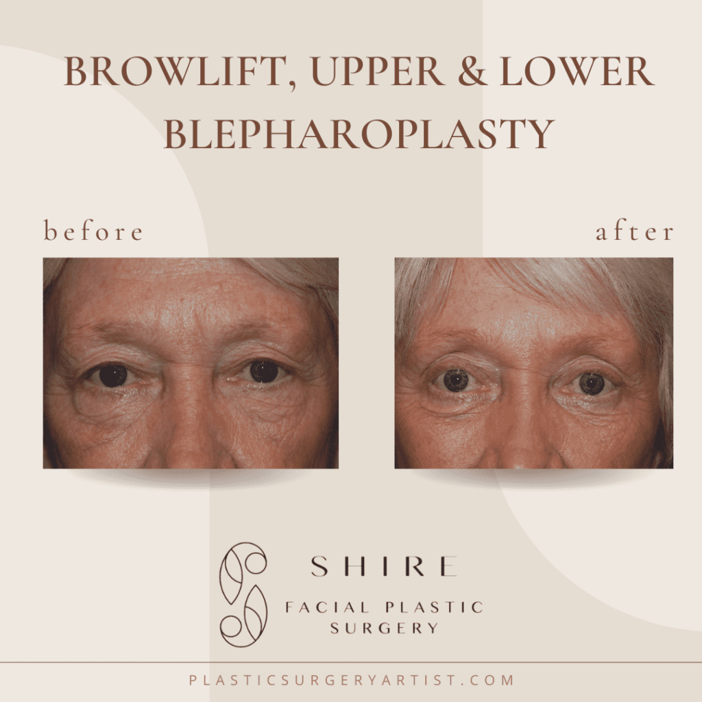 Browlift, Upper, and Lower Blepharoplasty