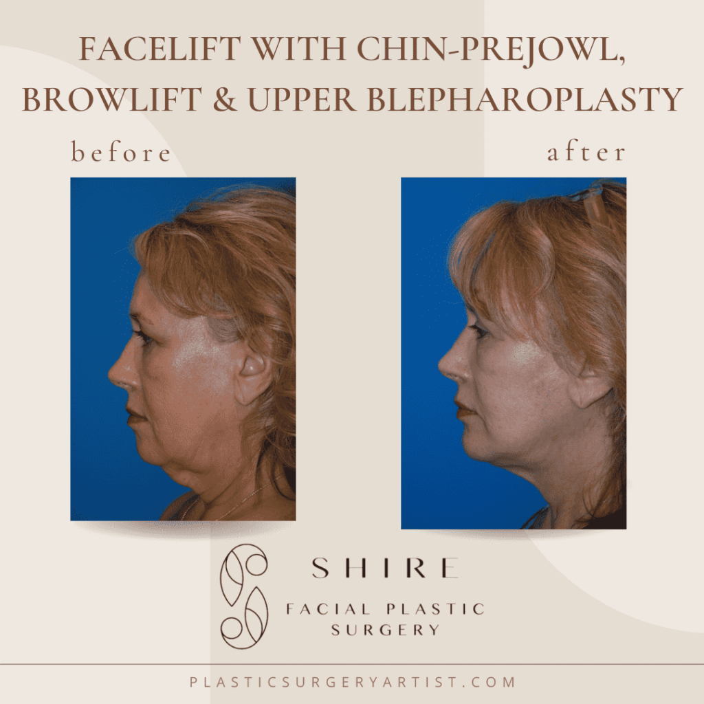facelift with chin prejowl, browlift and upper blepharoplasty