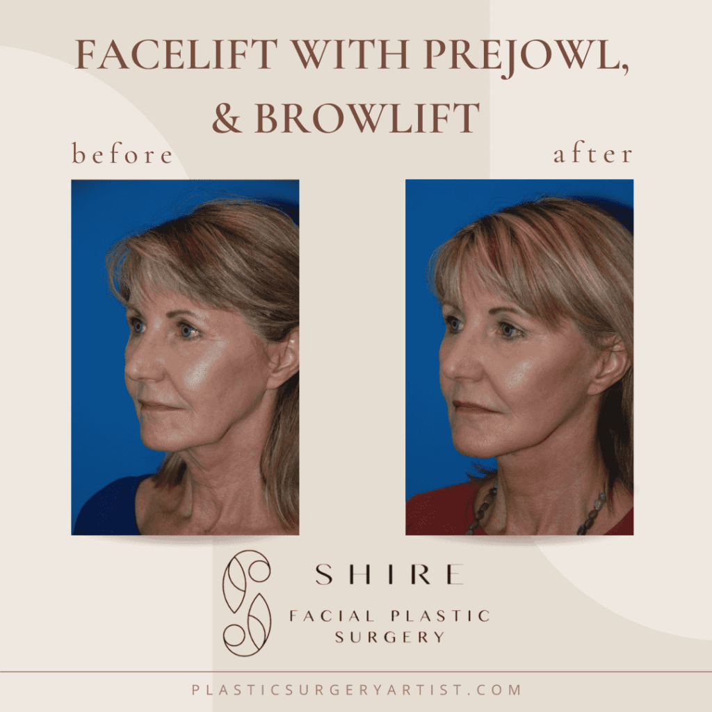 facelift with prejowl and browlift