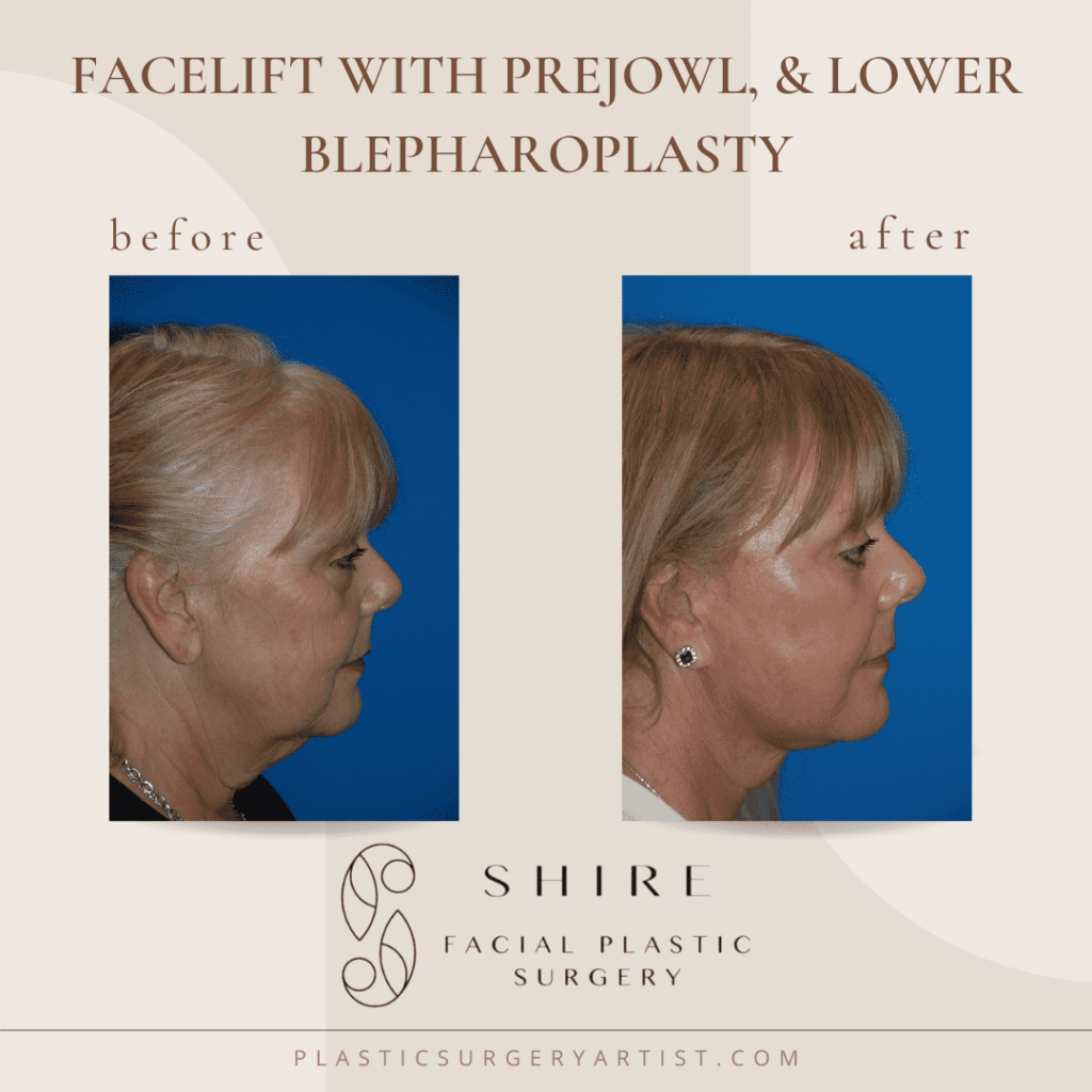 facelift with prejowl,, and lower blepharoplasty