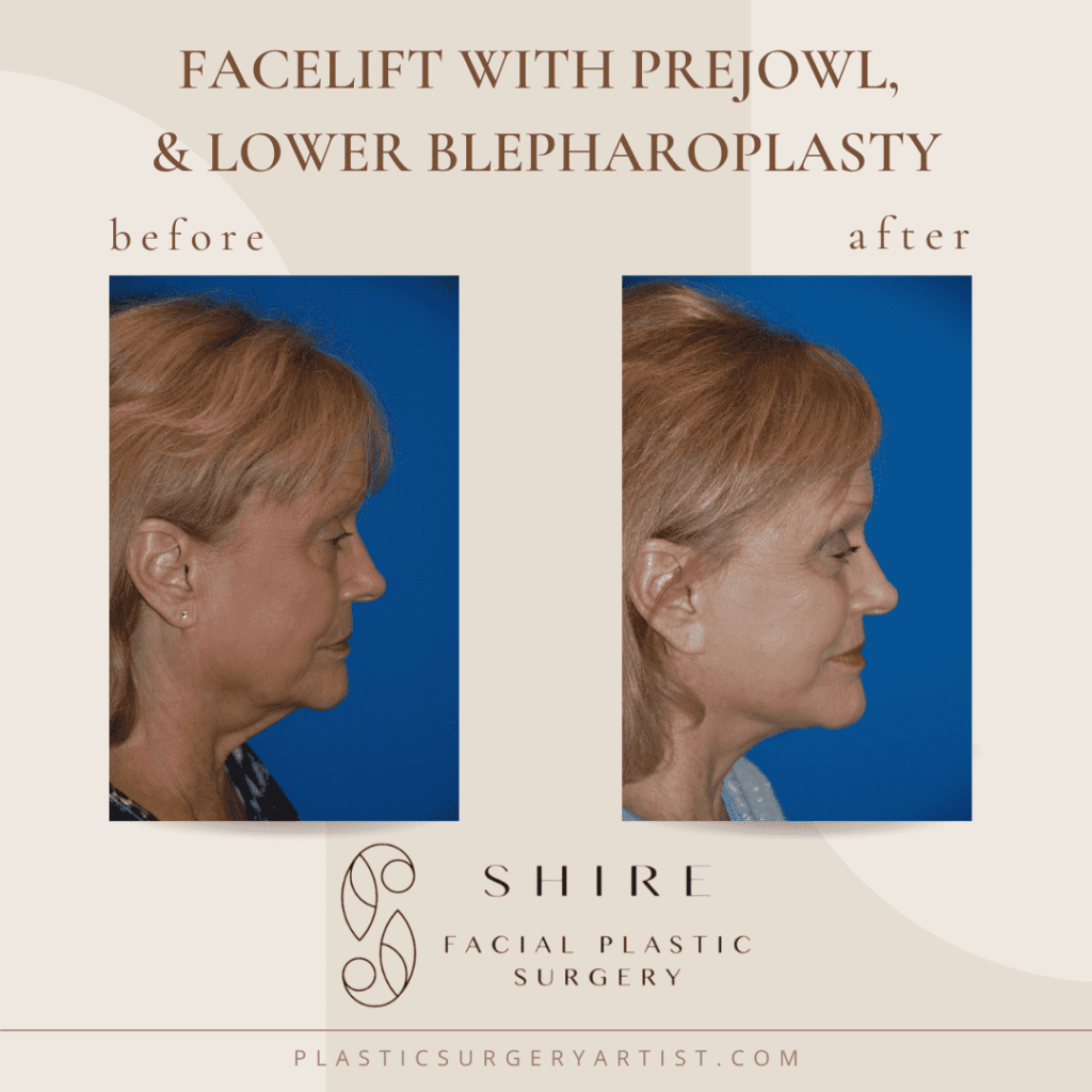 facelift with prejowl and lower blepharoplasty