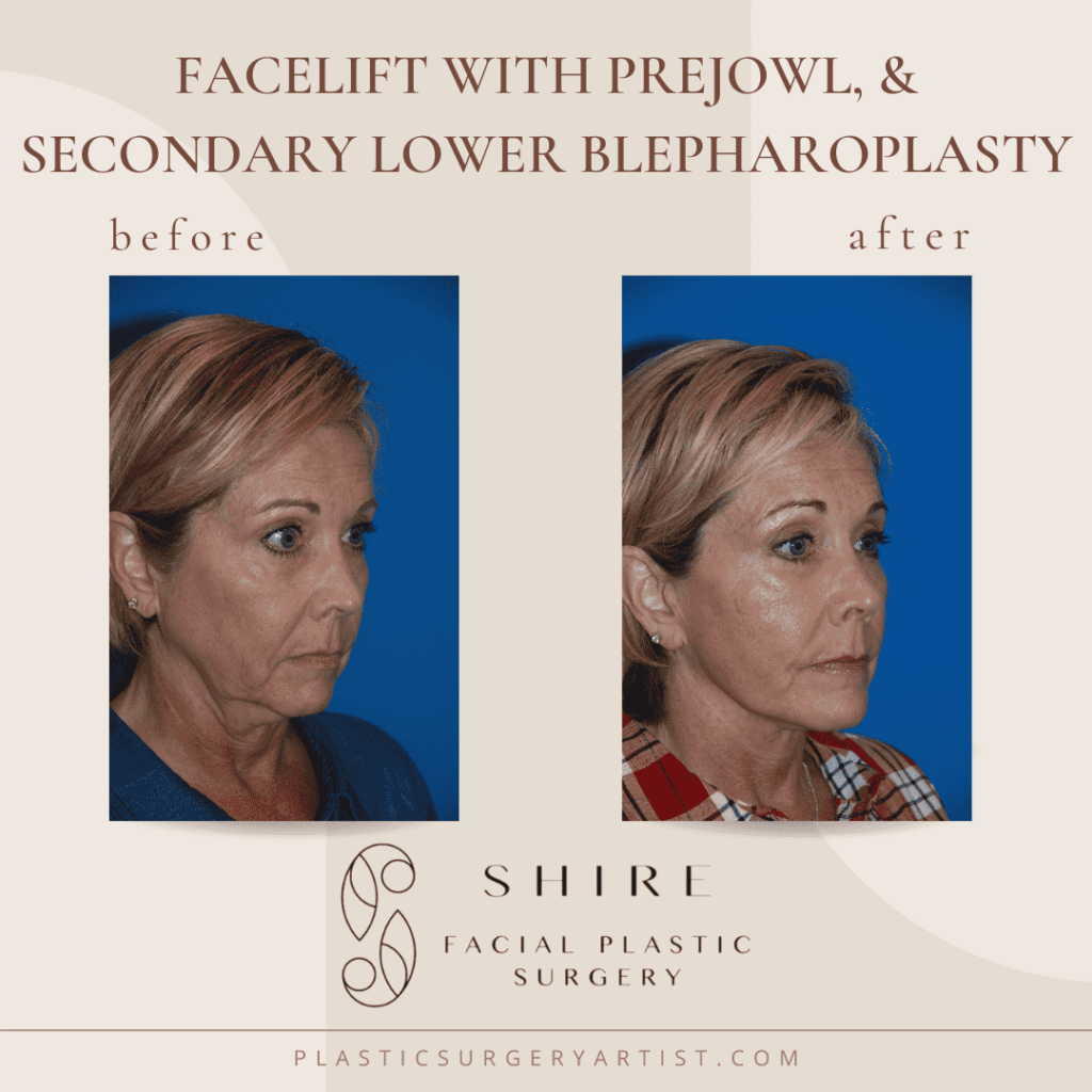 facelift with prejowl, and secondary lower blepharoplasty