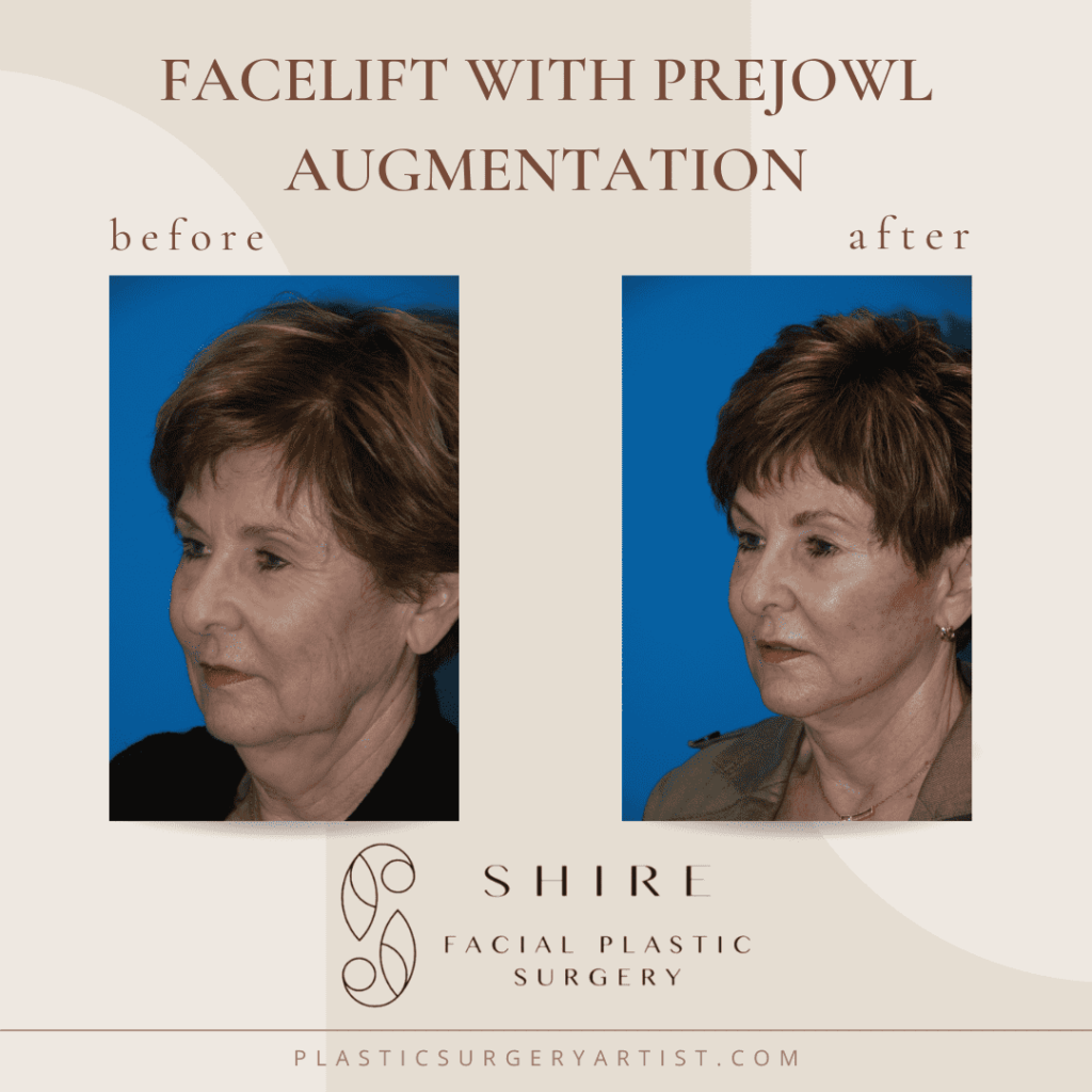 facelift with prejowl augmentation