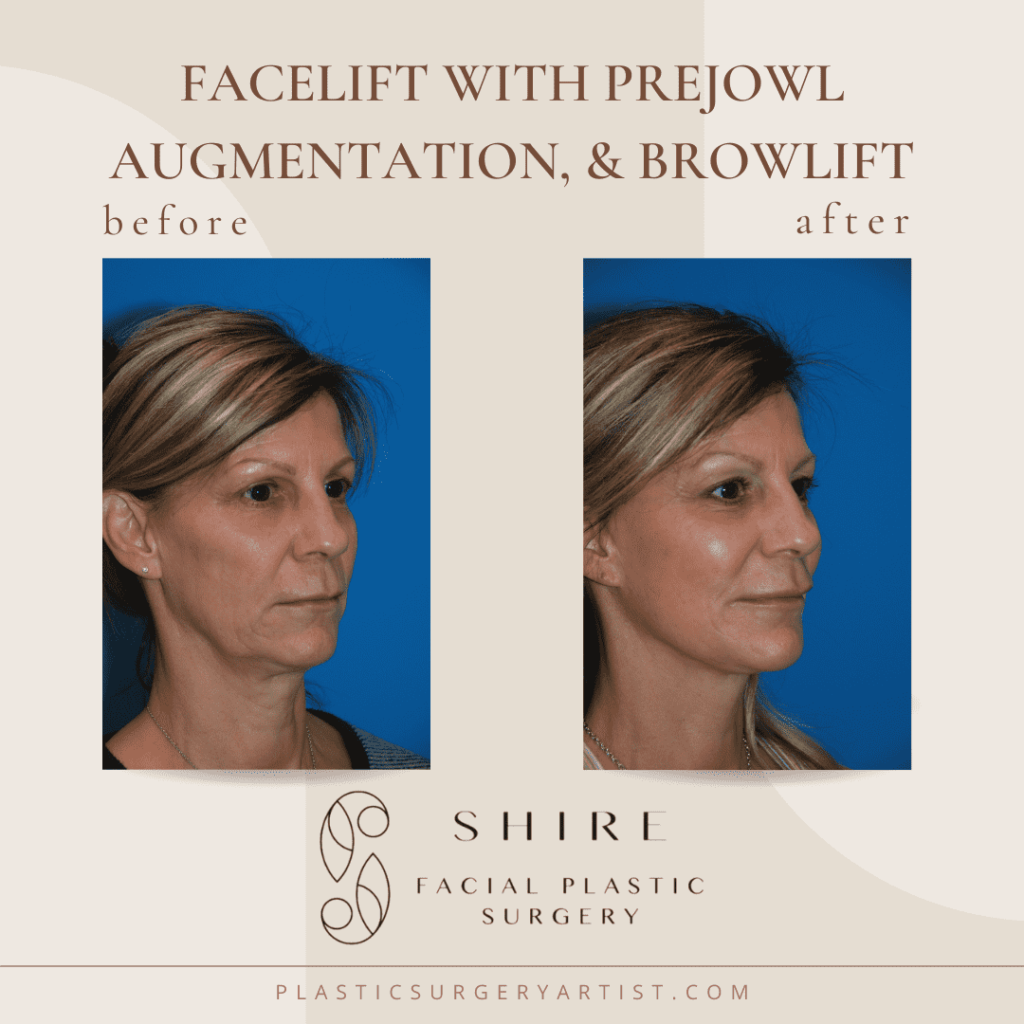 facelift with prejowl augmentation, and-browlift