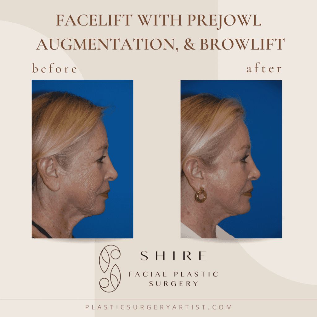 facelift with prejowl augmentation and browlift