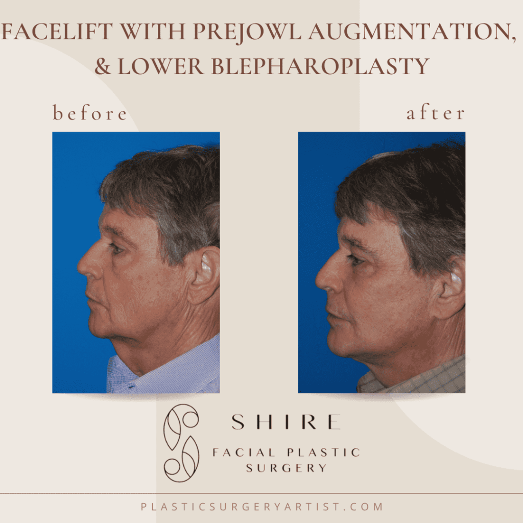 facelift with prejowl augmentation and lower blepharoplasty