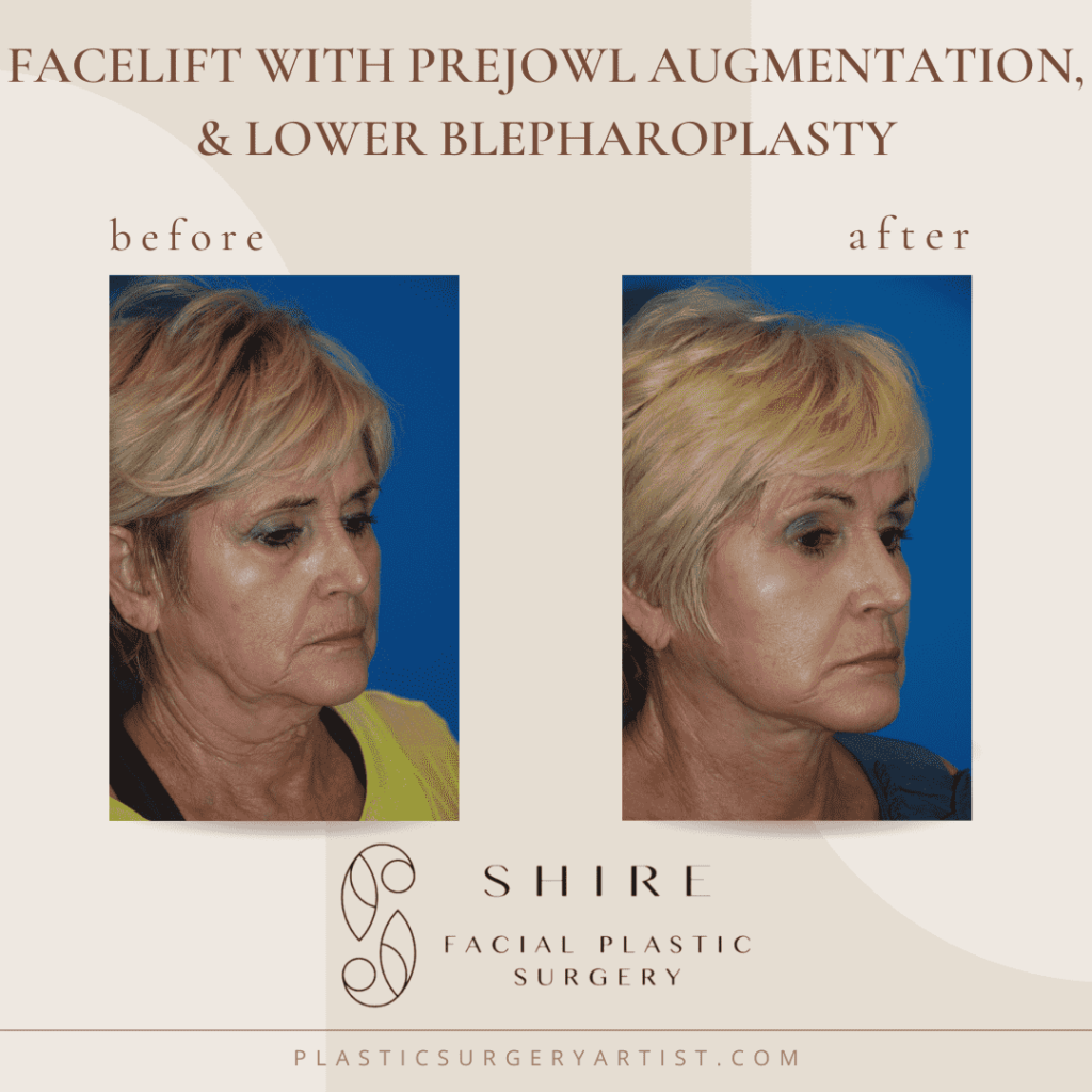 facelift with prejowl augmentation and lower blepharoplasty