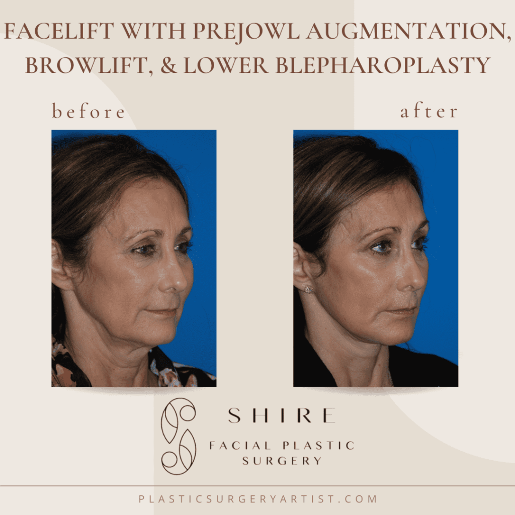 facelift with prejowl augmentation browlift and lower blepharoplasty
