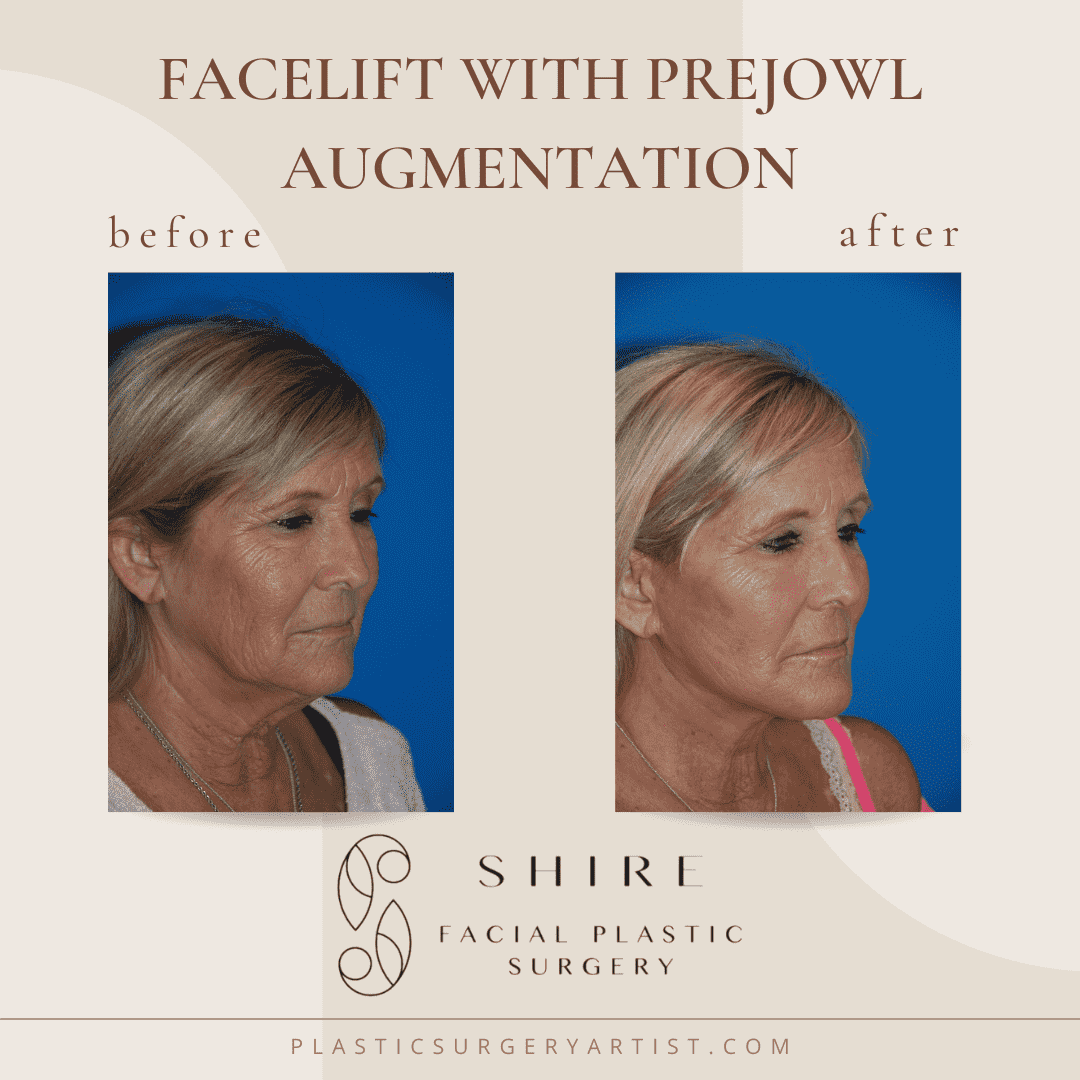 facelift-with-prejowl-augmentation | Shire Facial Plastic Surgery