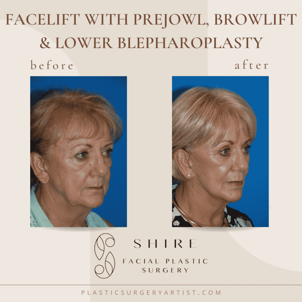 facelift with prejowl, browlift and lower blepharoplasty