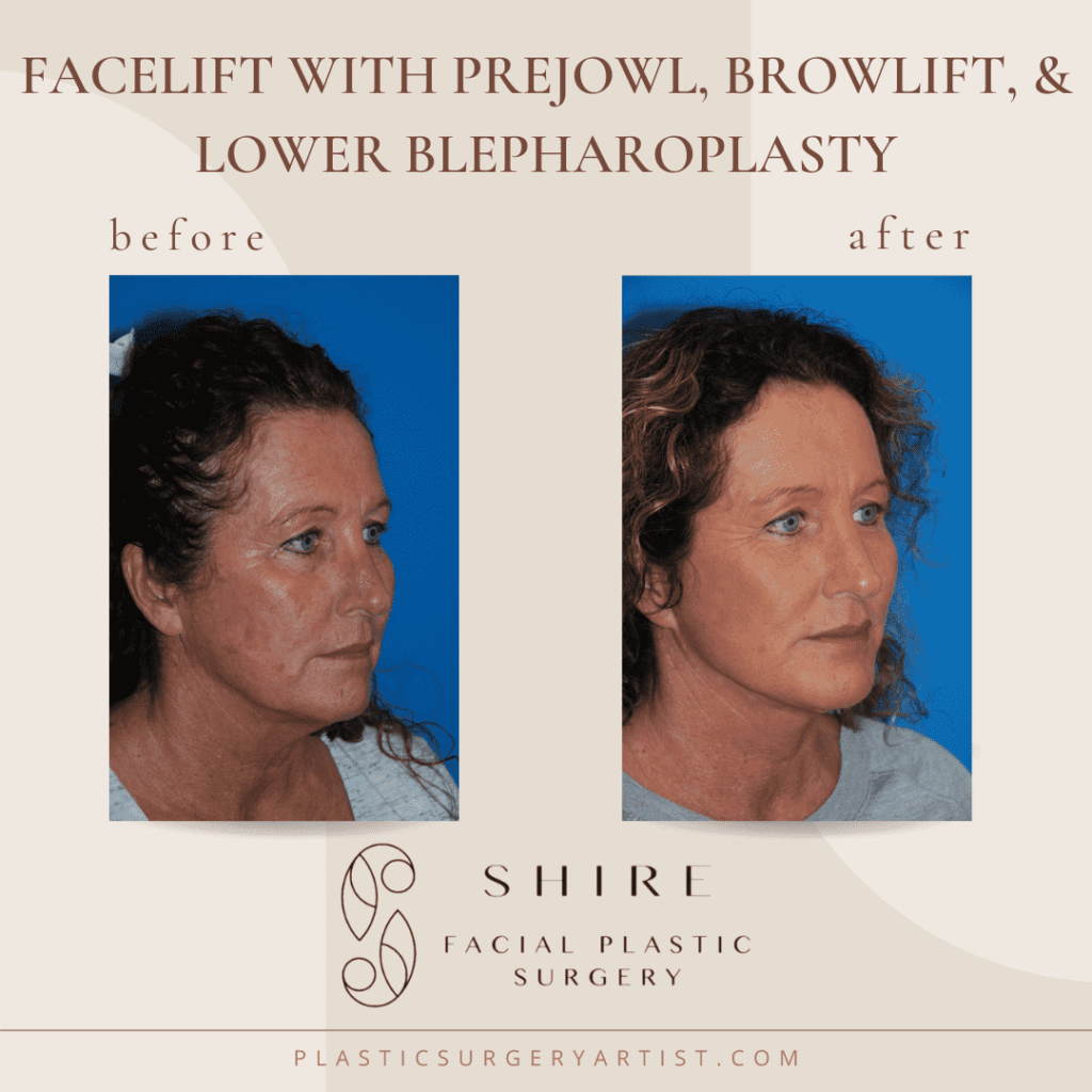 facelift with prejowl browlift and lower blepharoplasty