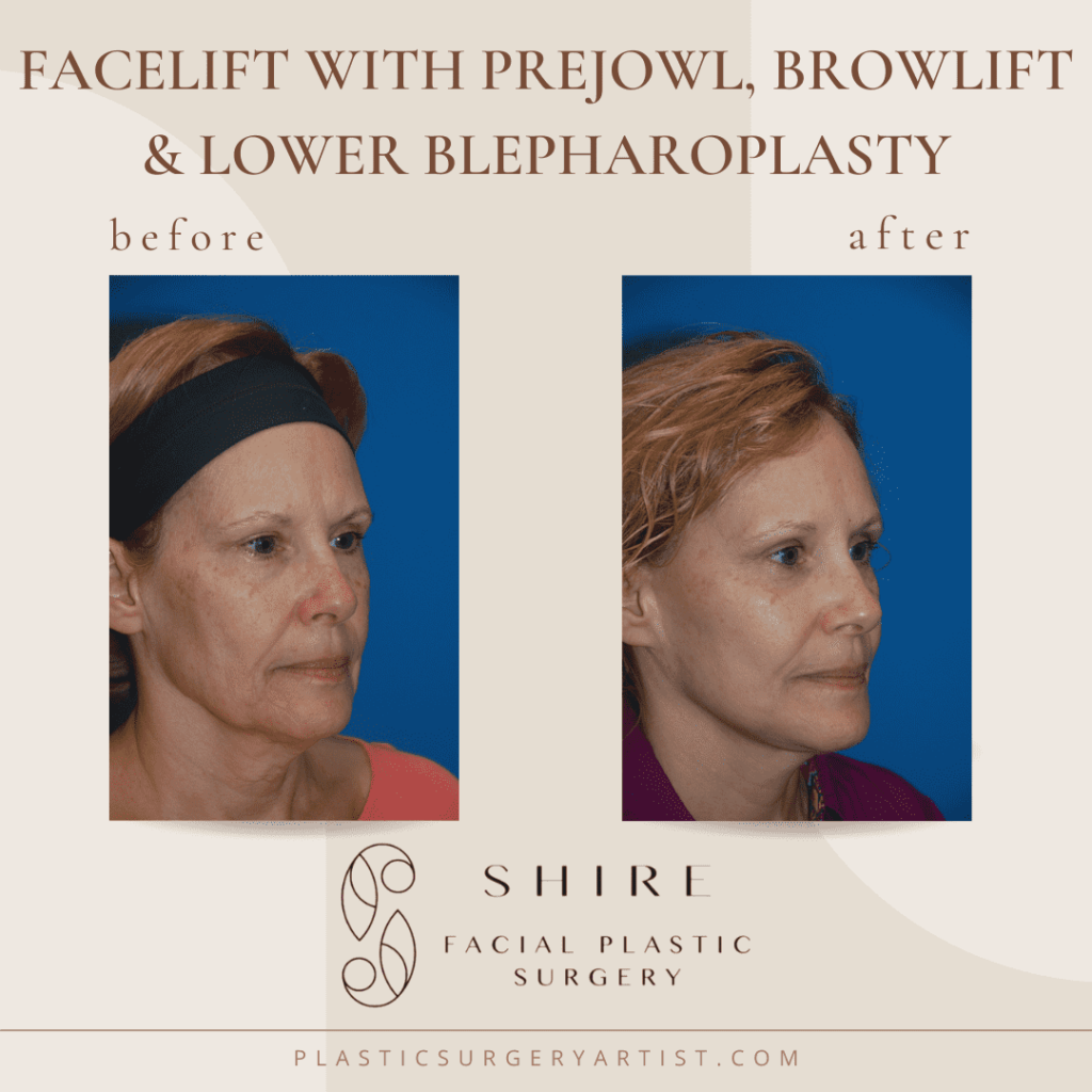 facelift with prejowl browlift and lower blepharoplasty 