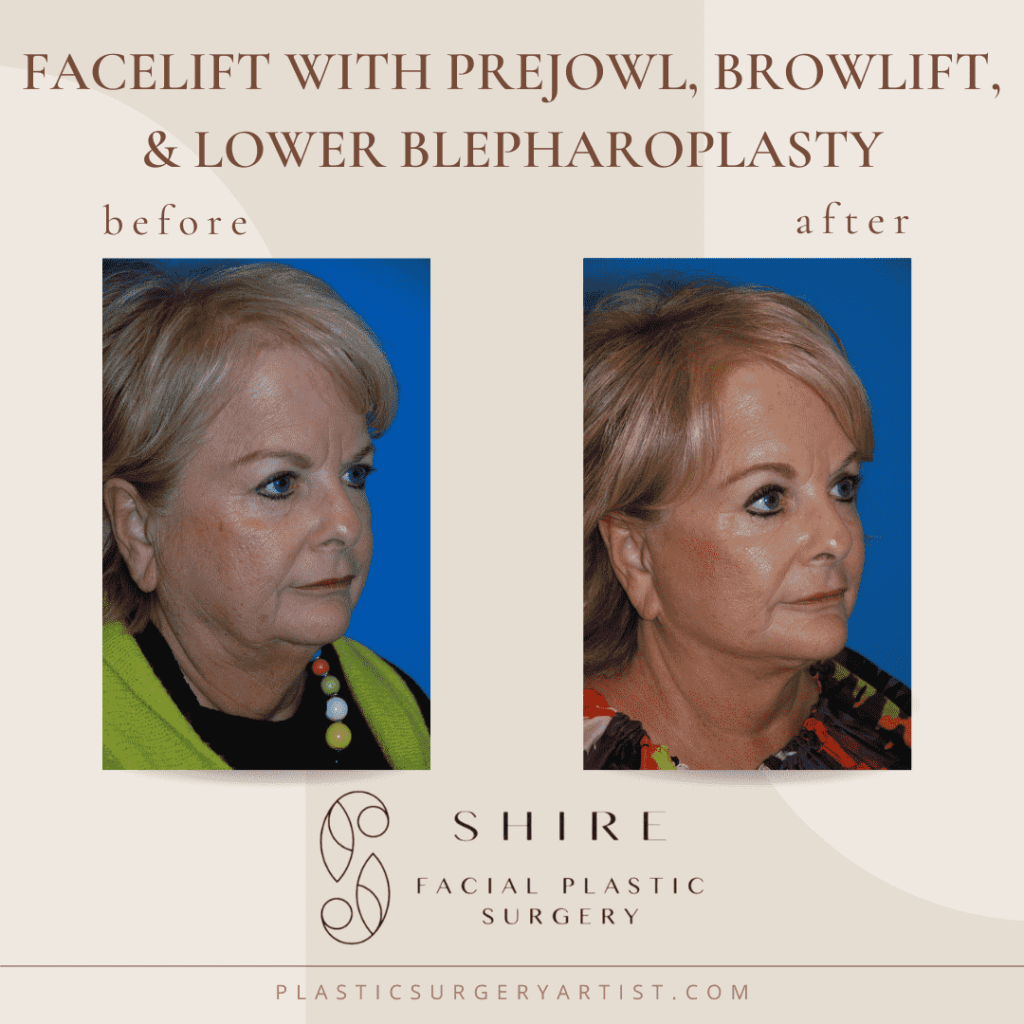facelift with prejowl, browlif, and lower blepharoplasty