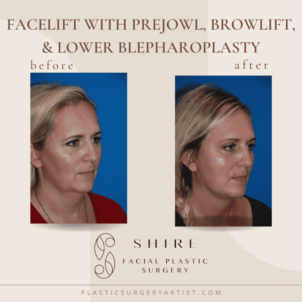 facelift with prejowl, browlift, and lower blepharoplasty