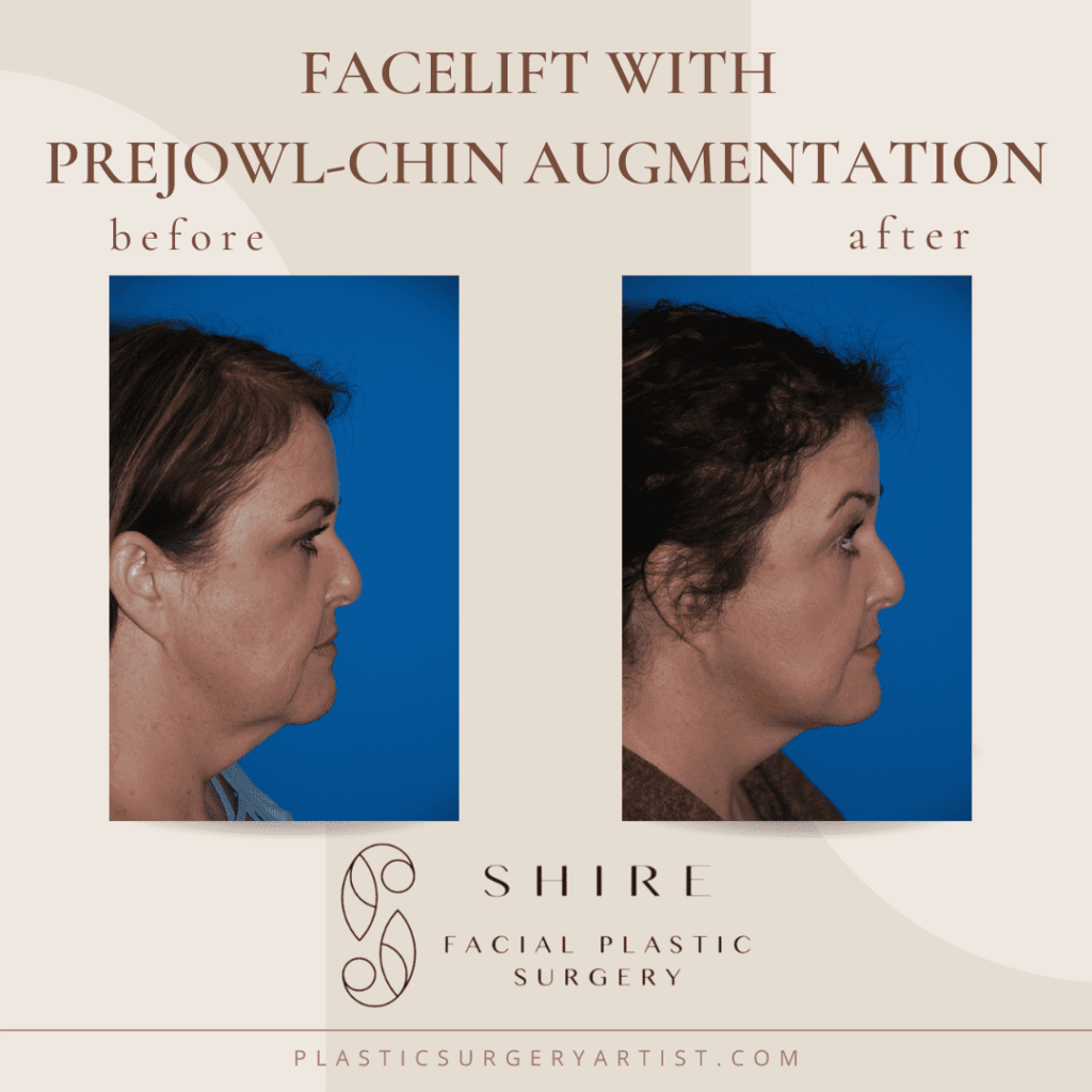 facelift with prejowl chin augmentation