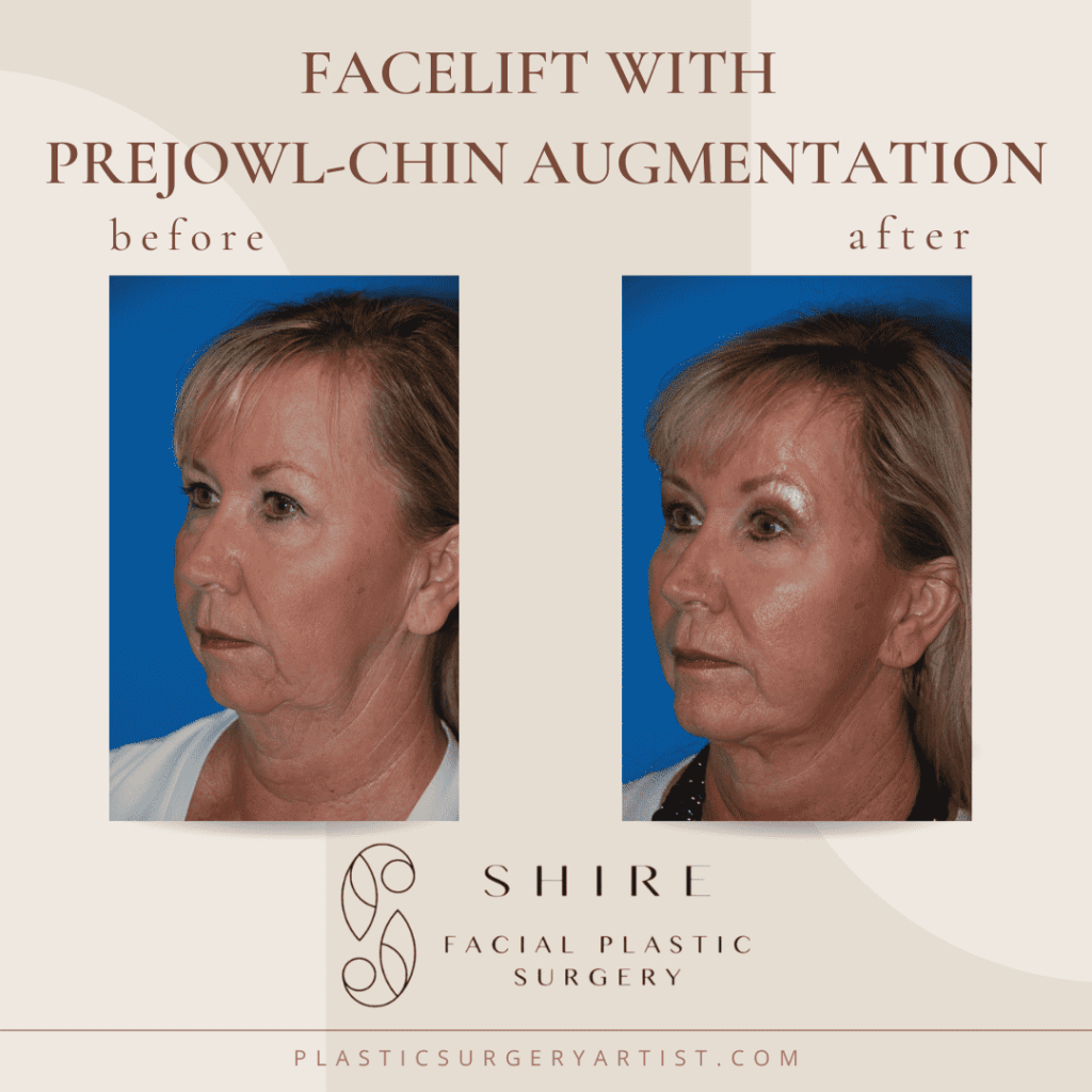 facelift with prejowl-chin augmentation