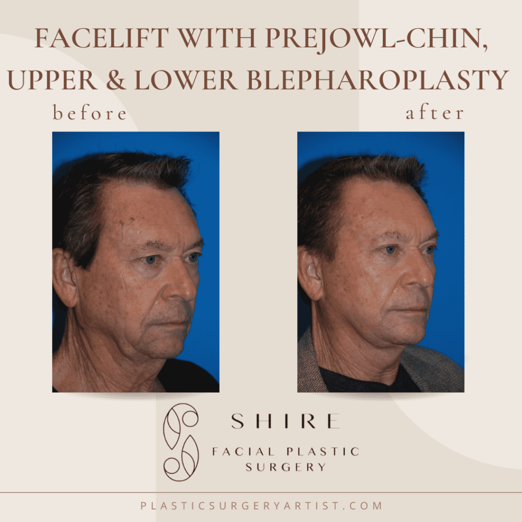 facelift with prejowl chin upper, and lower blepharoplasty
