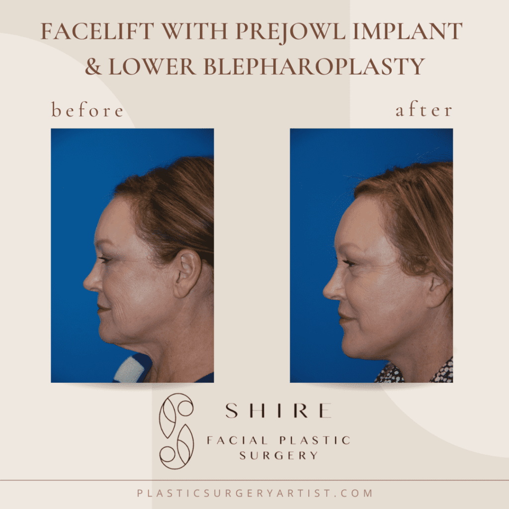 facelift with prejowl implant and lower blepharoplasty
