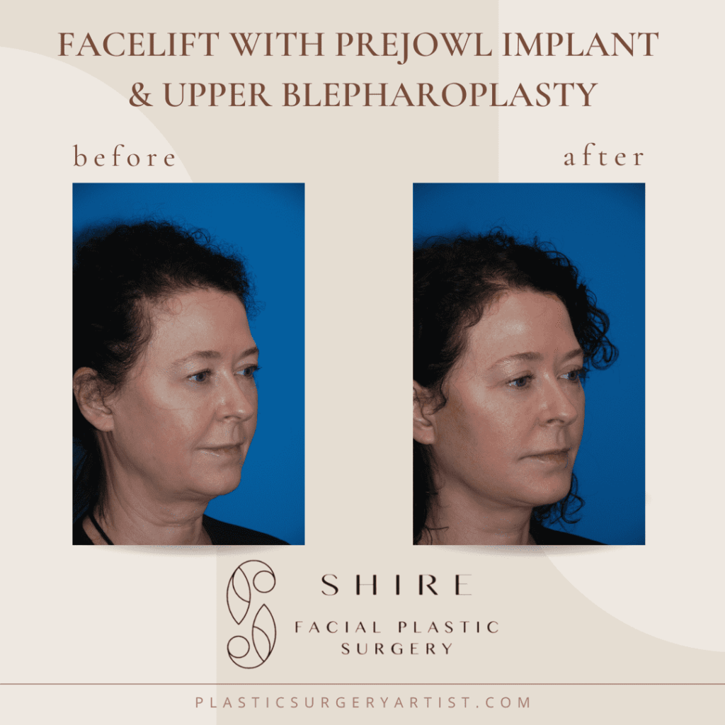facelift with prejowl implant and upper blepharoplasty