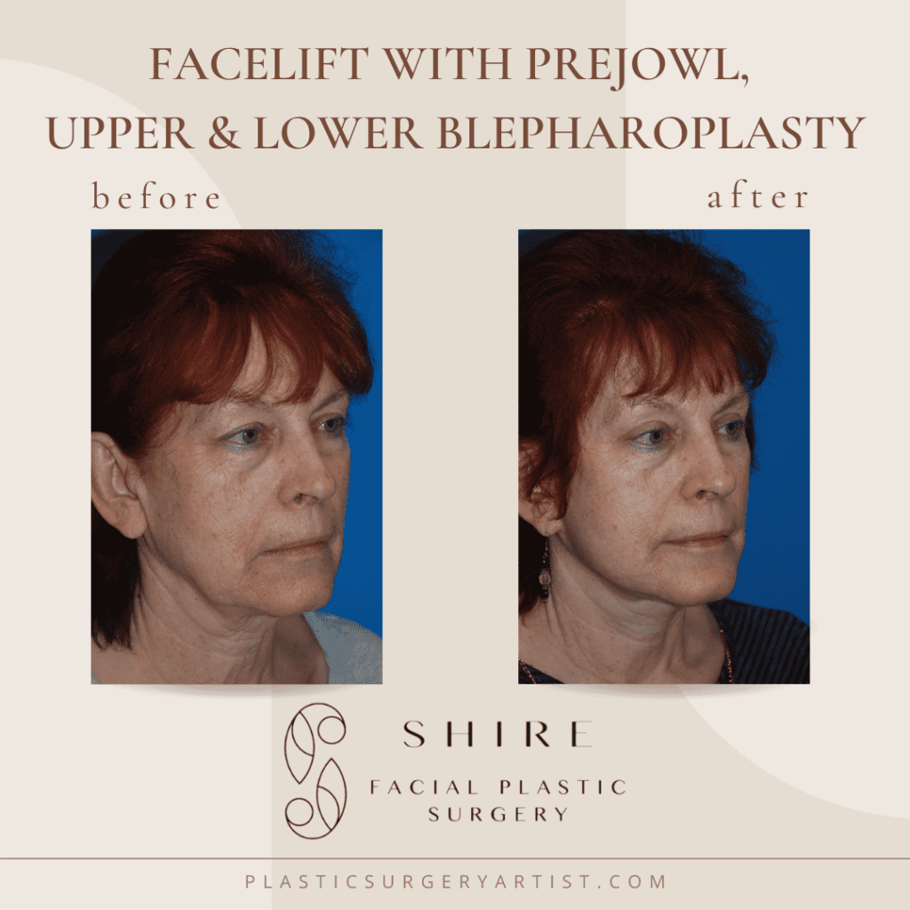 facelift with prejowl upper and lower blepharoplasty