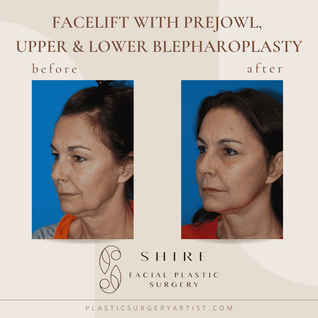 facelift-with-prejowl-upper-and-lower-blepharoplasty | Shire Facial ...