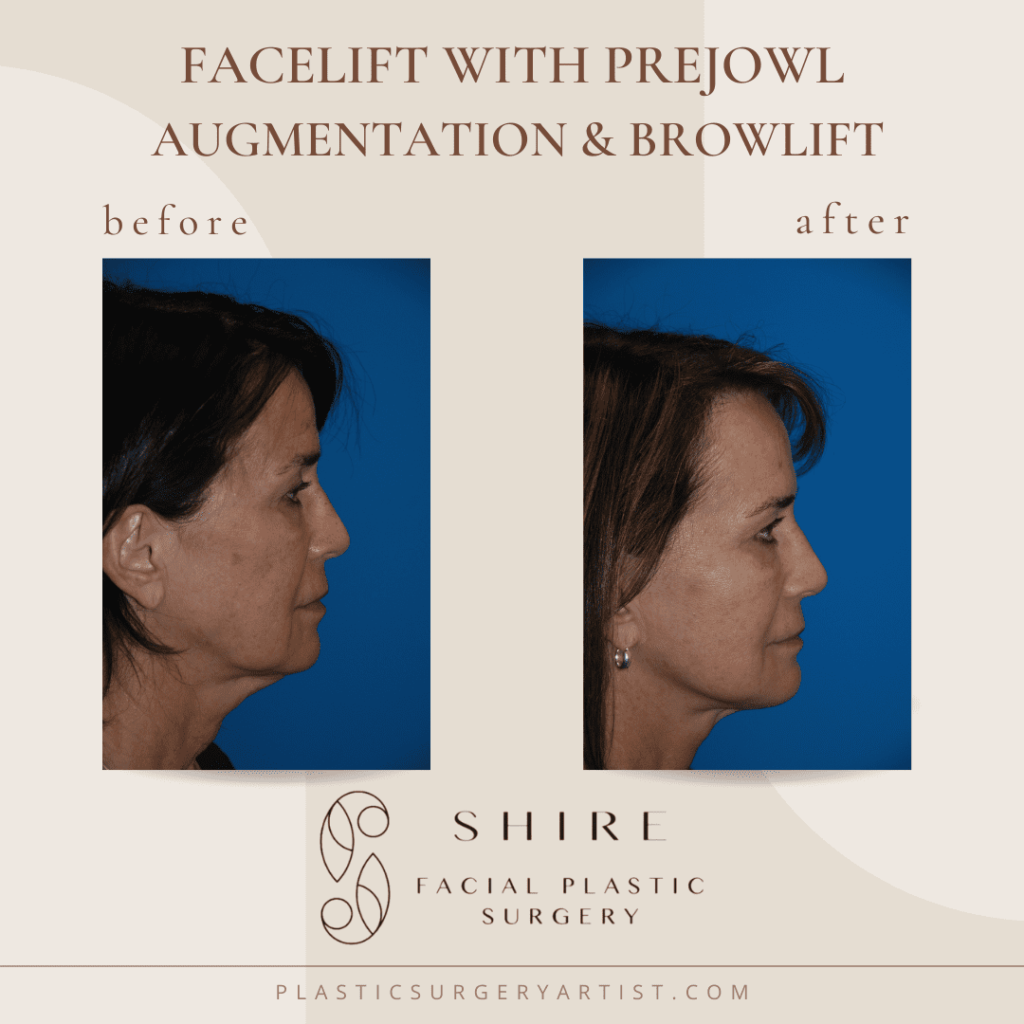 facelit with prejowl augmentation and browlift