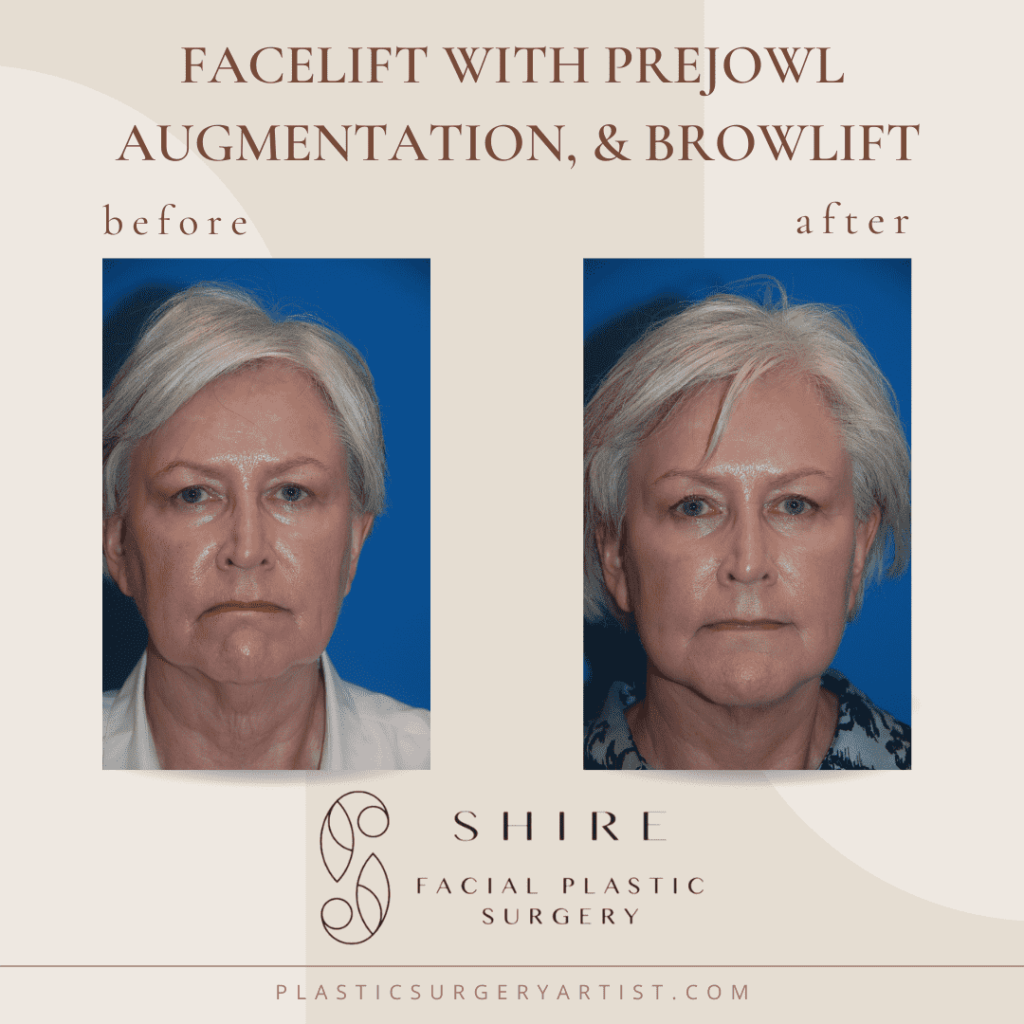 facelit with prejowl augmentation and browlift
