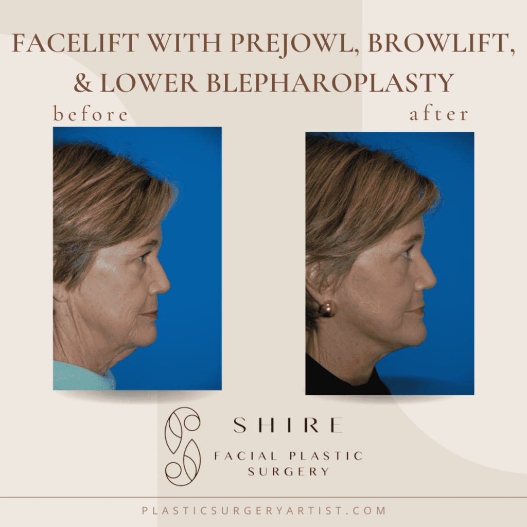 facelit with prejowl browlift and lower blepharoplasty