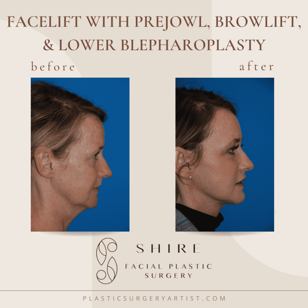facelit with prejowl, browlift, and lower blepharoplasty