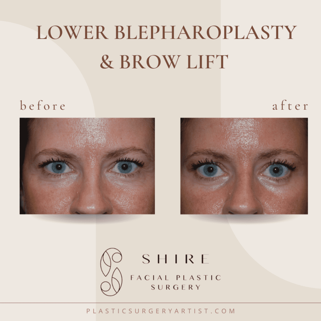 lower blepharoplasty and browlift