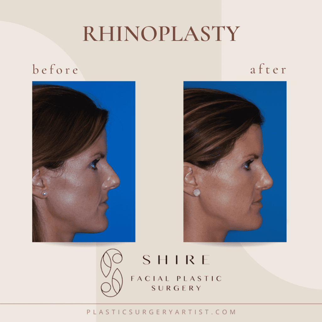 Rhinoplasty before and after - female patient 