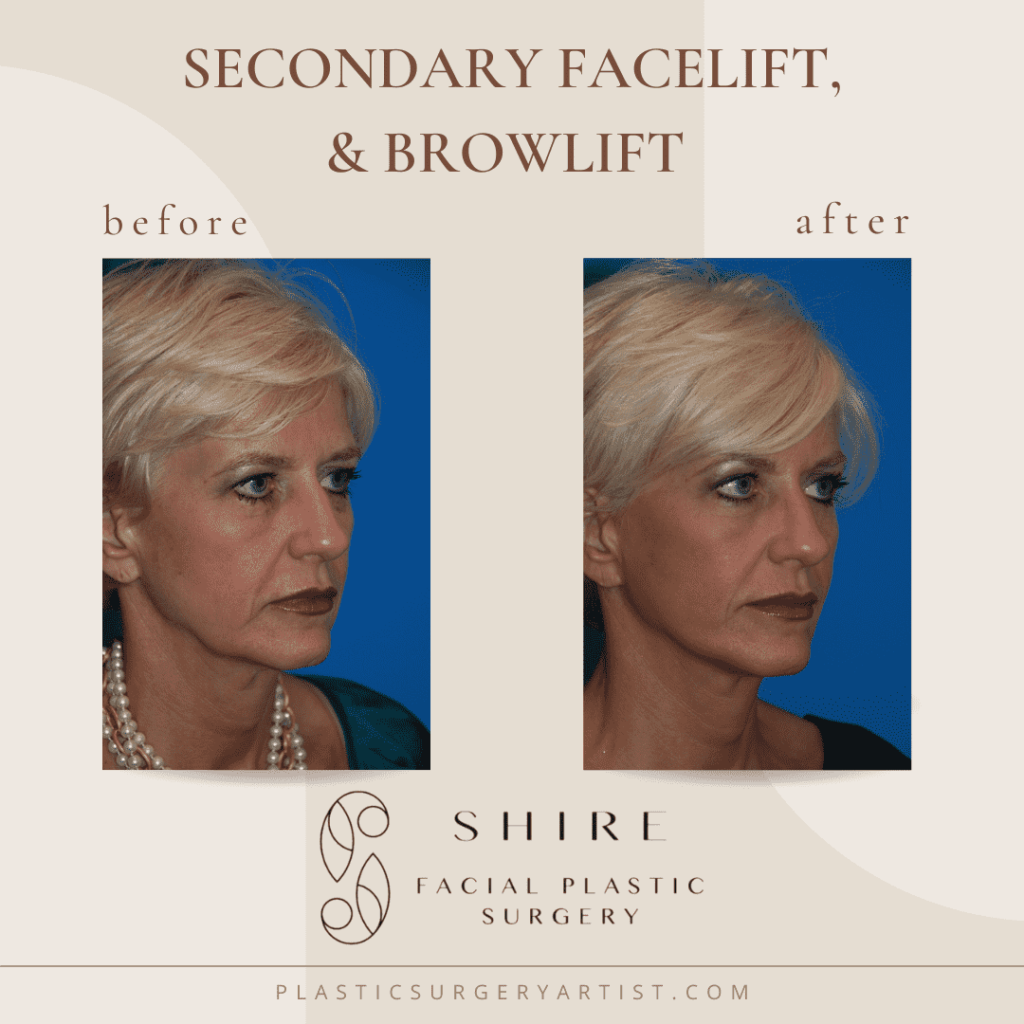 secondary facelift and browlift