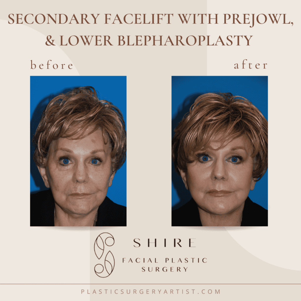 secondary facelift with prejowl and lower blepharoplasty